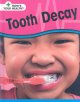 Go to record Tooth decay